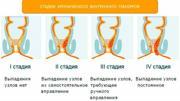 Стадии внутреннего хронического геморроя