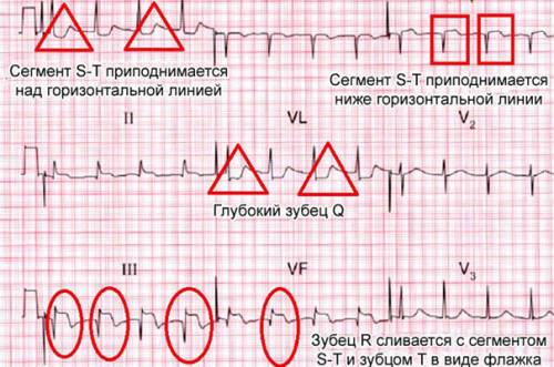 Инфаркт миокарда на ЭКГ