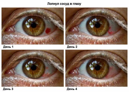 Динамика субконъюнктивального кровоизлияния 