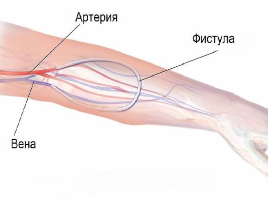 Артериовенозная фистула