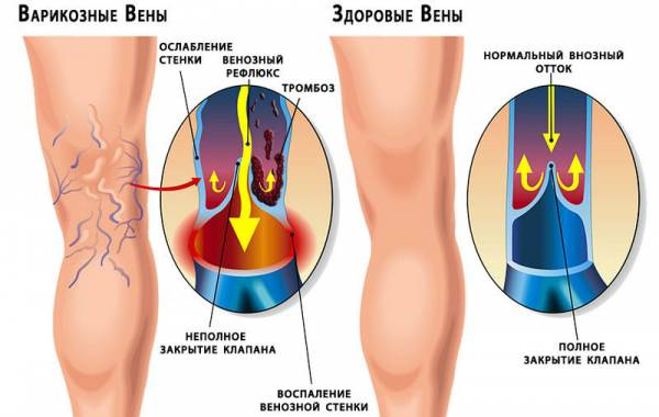 Варикозное расширение вен