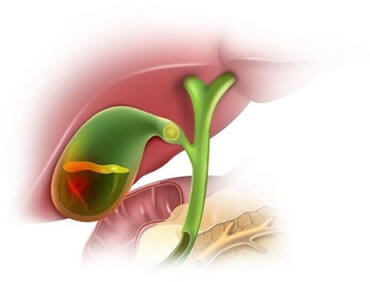 gallstones