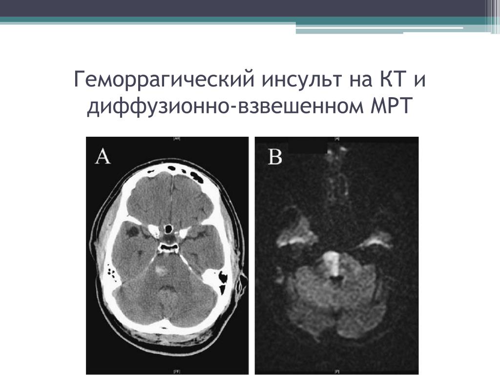 Геморрагический инсульт что это