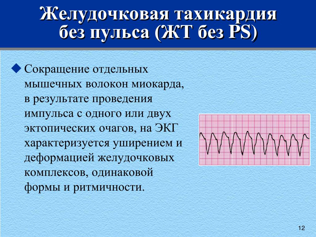 Тахикардия лечение. Желудочковая тахикардия без пульса. Желудочковая тахикардия без пульса на ЭКГ. Желудочковая тахикардия. Фибрилляция желудочков и желудочковая тахикардия без пульса.