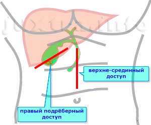 хирургические доступы для открытой холецистэктомии