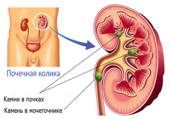 Можно ли кофе при мочекаменной болезни