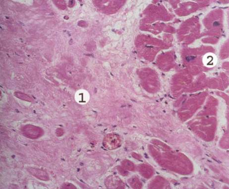 Кардиосклероз рисунок микропрепарат
