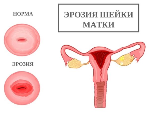 эрозия шейки матки