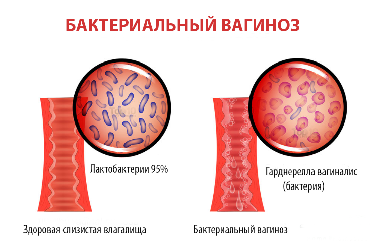 бактериальный вагиноз