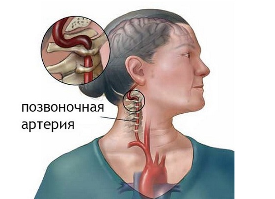 Сужение сосудов шейного отдела позвоночника симптомы и лечение