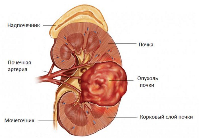 гиперваскулярное образование почки