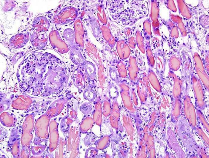 Нефроз. Миоглобинурийный нефроз. Десквамативный нефроз. Периколлагеновый амилоидоз гистология.