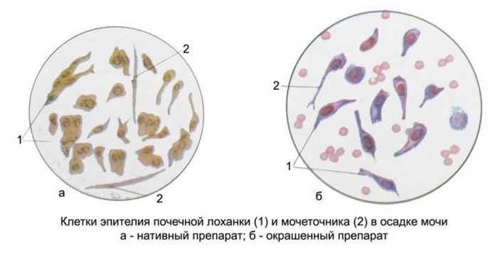 почечный эпителий в моче