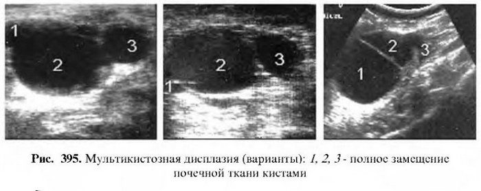 дисплазия почек