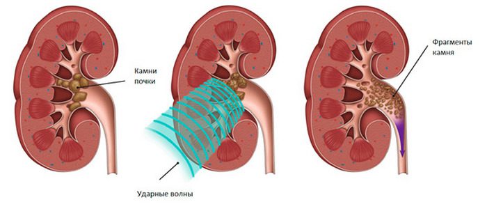 солевой диатез почек лечение