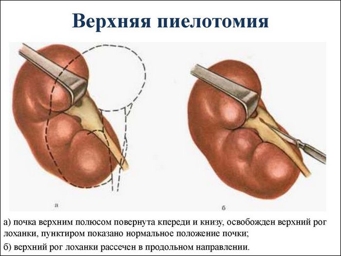 операция на почки