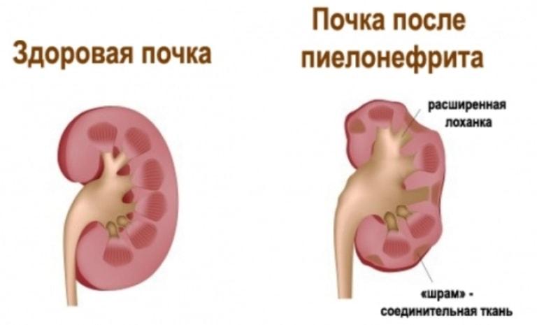 Нефрит почек