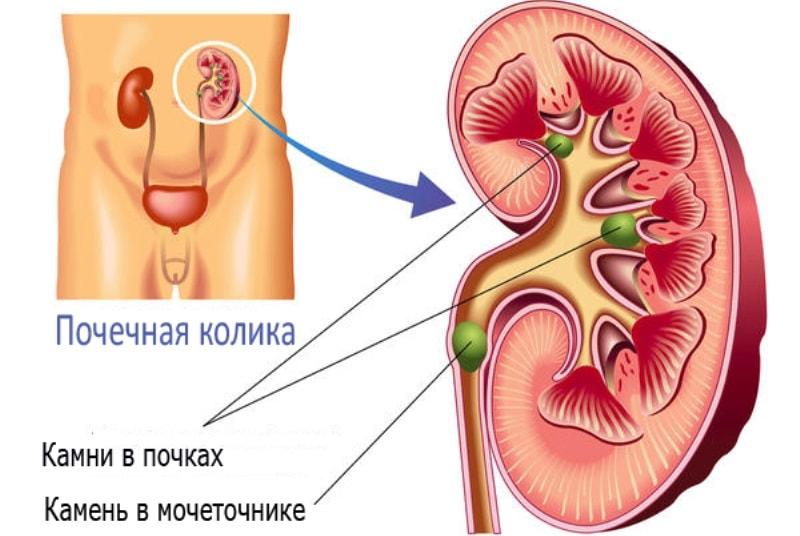 Почечная колика