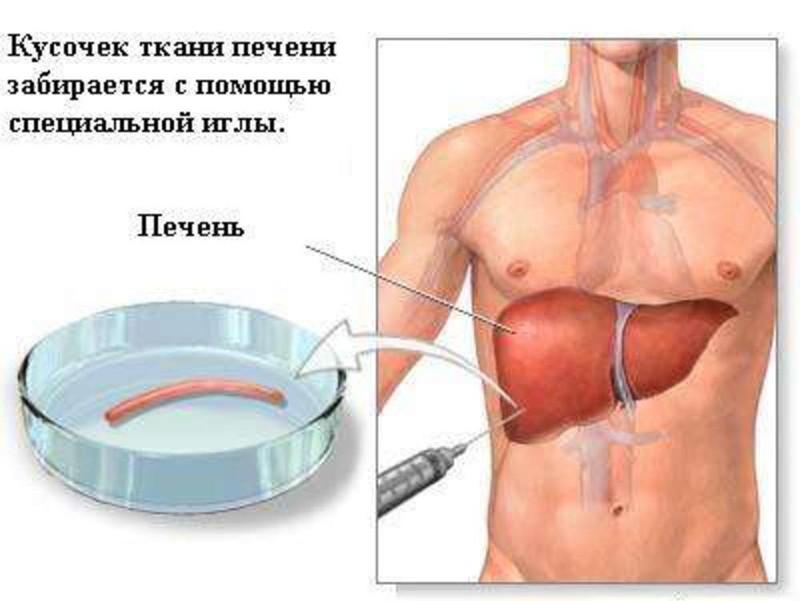 биопсия печени