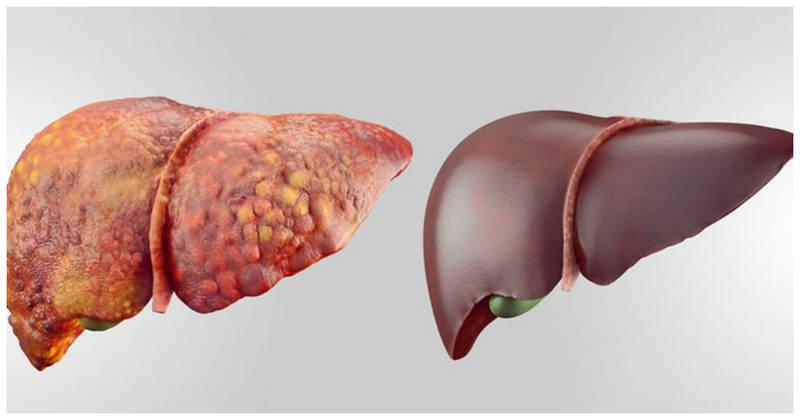 здоровая и больная печень