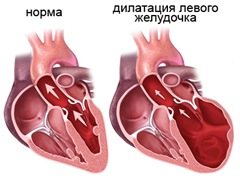 Дилатация левого желудочка