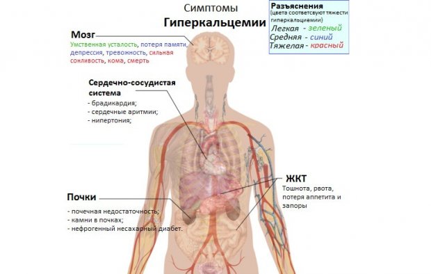 Гиперкальцемия