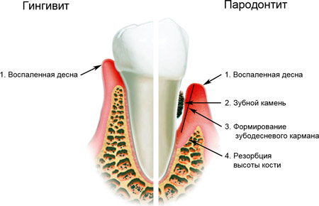 Парадонтит и гингивит