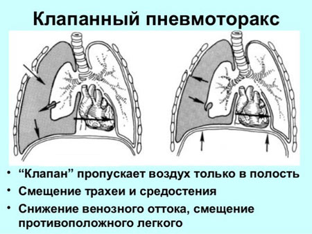 Пневмоторакс