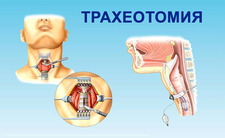 Трахеотомия