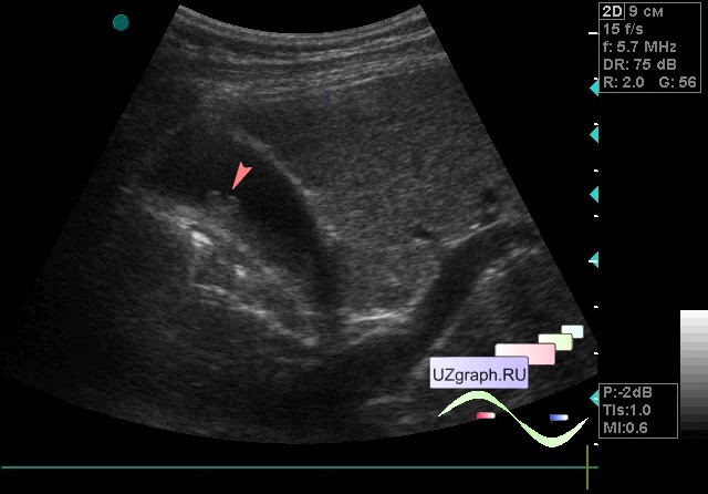 Полип желчного пузыря на узи. Нефункционирующий желчный пузырь на УЗИ. Ультрасонография желчного пузыря полип. Холестериновый полип на УЗИ.