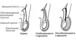 Формы водянки яичек