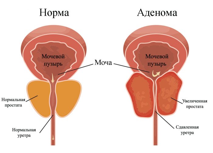 поражение половых органов