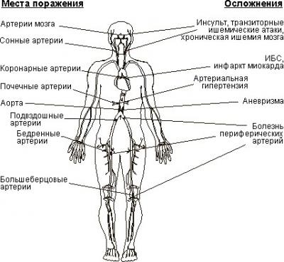 Поражения при атеросклерозе