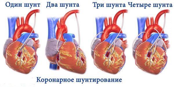 Шунты в сердце