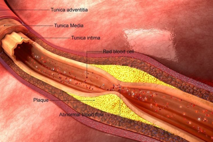 Как забиваются артерии?