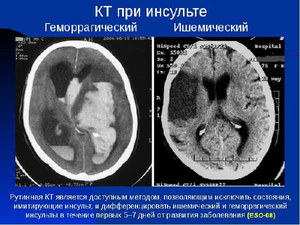 Снимок головного мозга с ишемическим инсультом