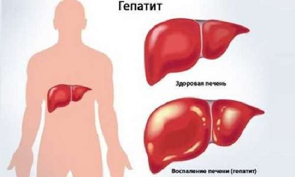 Гепатит