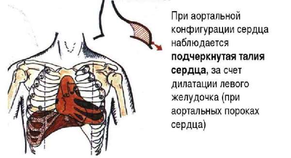 Аортальная форма сердца