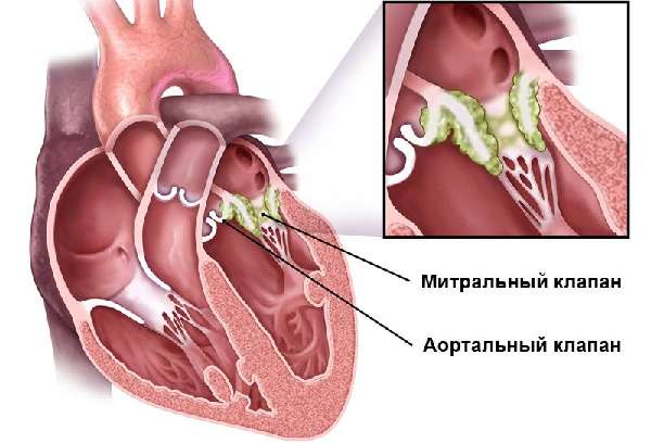 Эндокардит