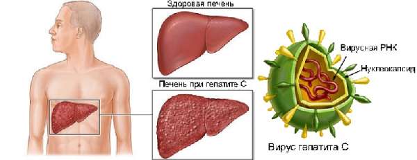 Гепатит С