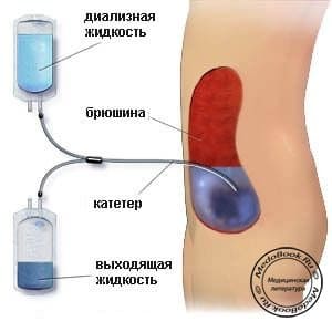 Схематическое изображение сеанса перитонеального диализа