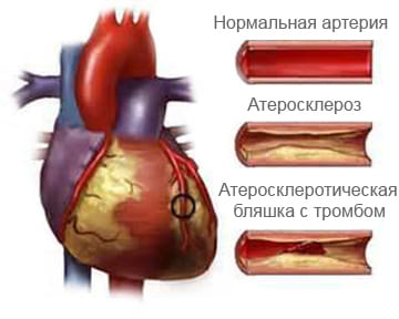 Нестабильная стенокардия