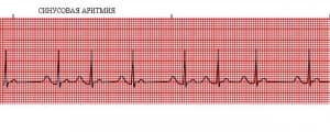 Синусовая аритмия