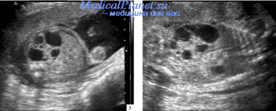 Мультикистозная дисплазия почек. Узи диагностика мультикистозной ...
