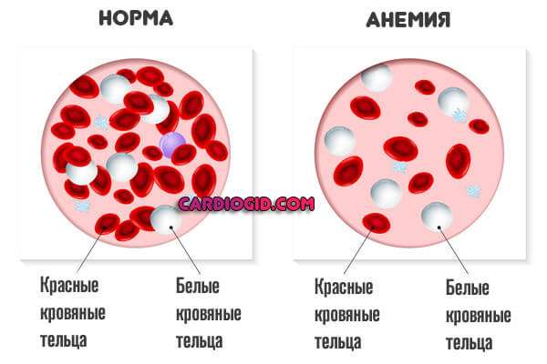 анемия