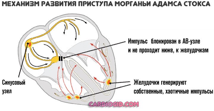 синдром-мэс