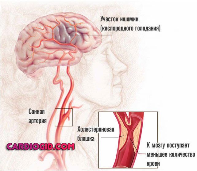 цереброваскулярная-недостаточность