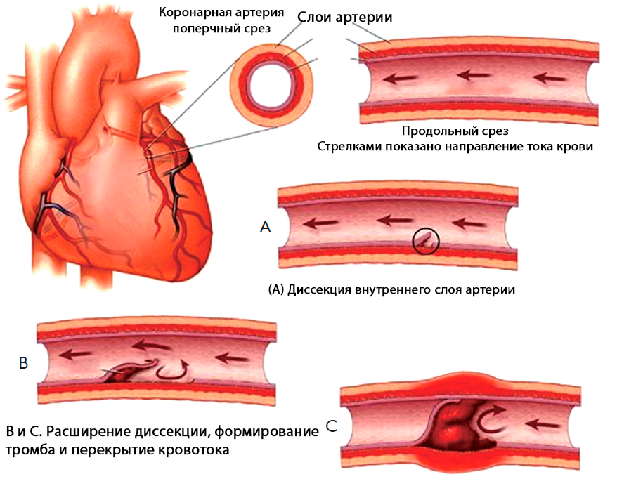 Инфаркт коронарное стентирование. Осложнения стентирования коронарных артерий сердца. Инфаркт миокарда стентирование осложнения. ИБС атеросклероз коронарных артерий. Стентирование коронарных сосудов осложнения.
