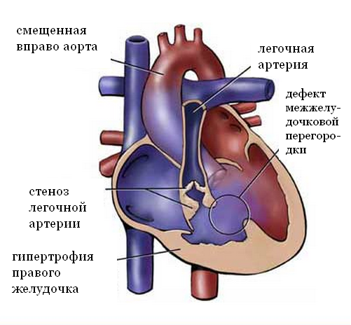 тетрада фалло