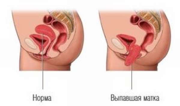 Нефроптоз